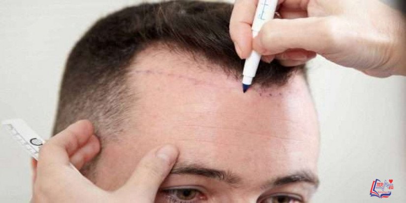 عملية زراعة الشعر تخلص من الصلع نهائيا