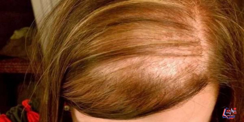 زراعة الشعر للنساء وأنواعها وتكلفتها