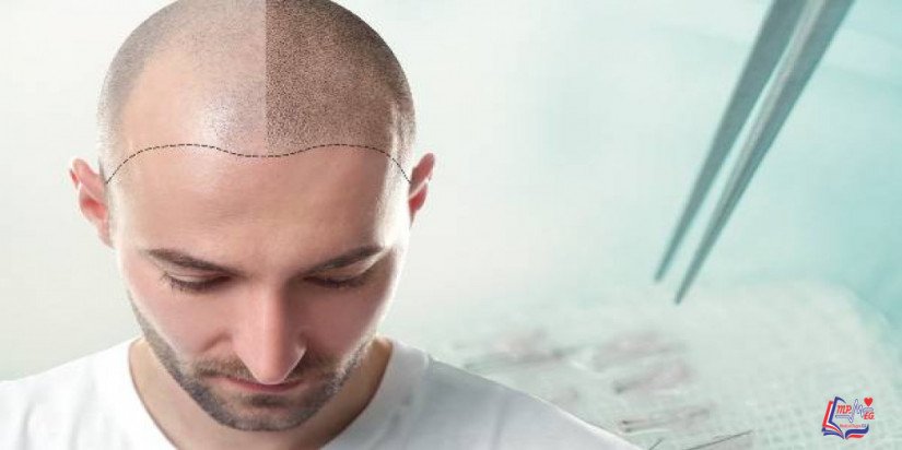 زراعة الشعر الطبيعي كيف تتم و تكلفة زراعة الشعر