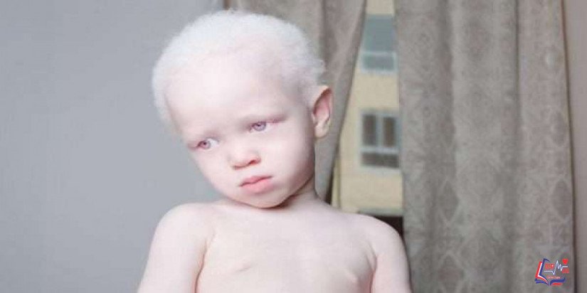 المهق Albinism عند الأطفال .. أسبابه وتأثيره على الطفل