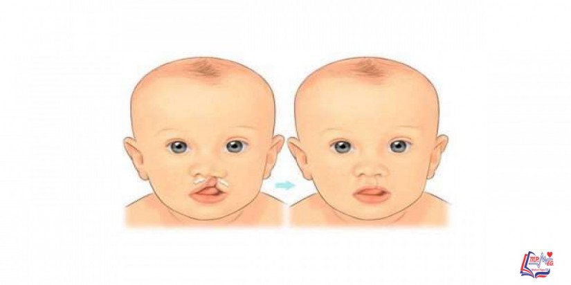 الشفه الارنبيه وشق سقف الحلق Cleft lip and cleft palate