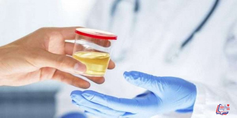 تغير لون البول Urine color