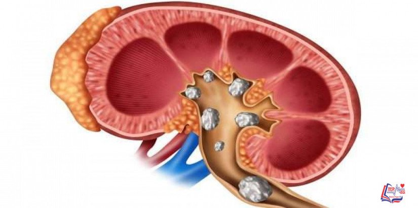 حصى الكلى Kidney stones