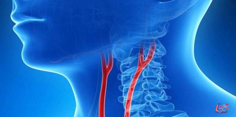 مرض الشريان السباتي Carotid artery disease