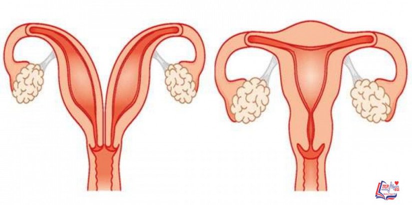 الرحم المزدوج Double Uterus