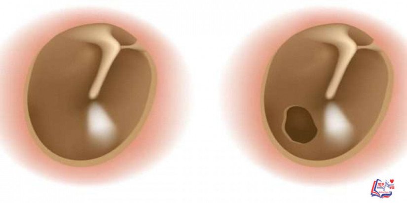 ثقب طبلة الاذن Ruptured eardrum