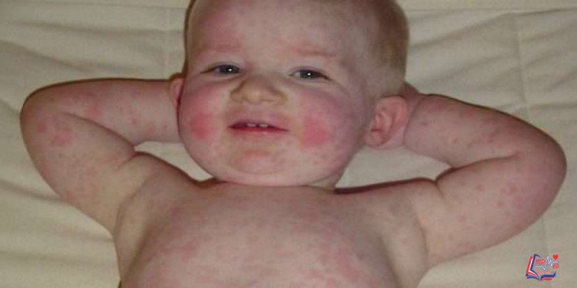 المرض الخامس Fifth disease