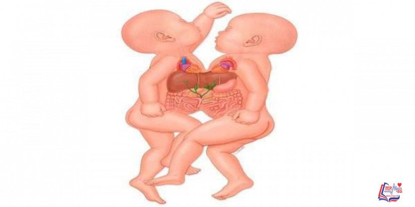 التوأم الملتصق Conjoined twin