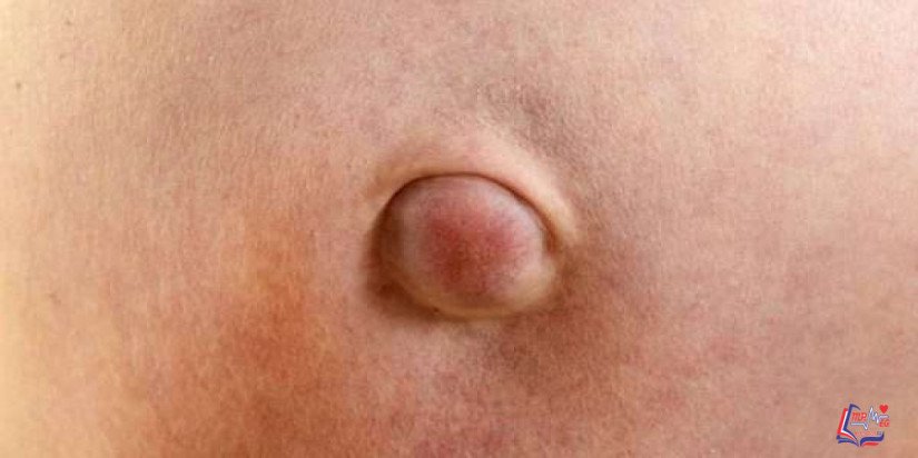 الفتق السري Umbilical hernia