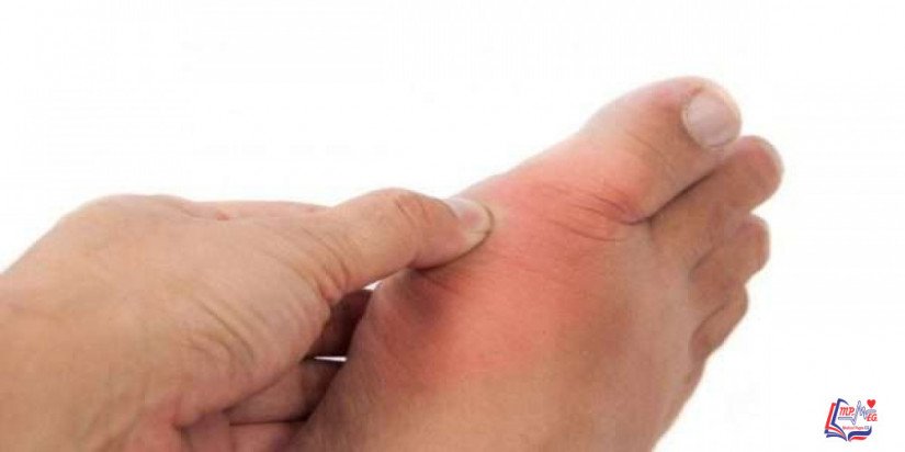 ثآليل القدم Plantar warts