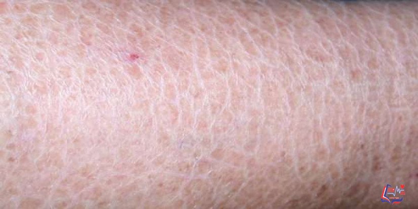 مرض السماك الشائع Ichthyosis vulgaris