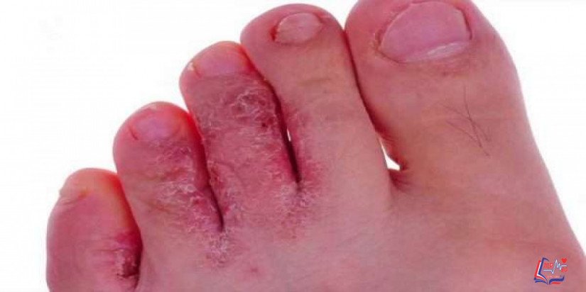 قدم الرياضي Athlete’s foot