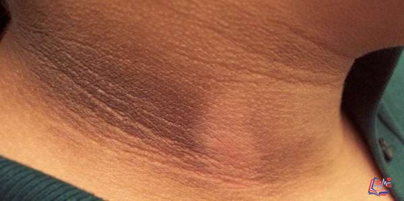 الشواك الأسود  Acanthosis nigricans