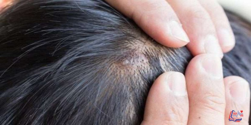 صدفية فروة الرأس Scalp psoriasis