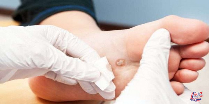 الثآليل الشائعة Common warts