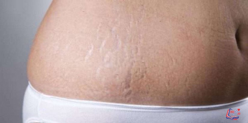 علامات تمدد الجلد stretch mark