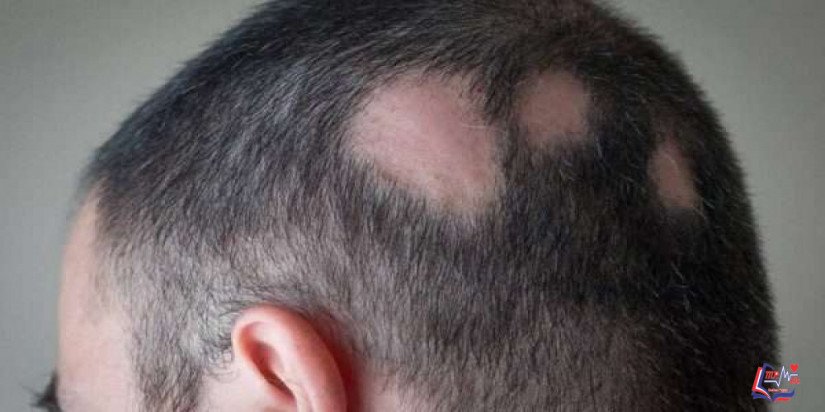 الثعلبة Alopecia areata