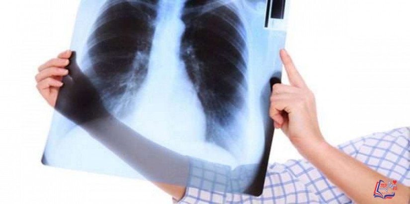 التهاب الشعب الهوائية المزمن Chronic bronchitis