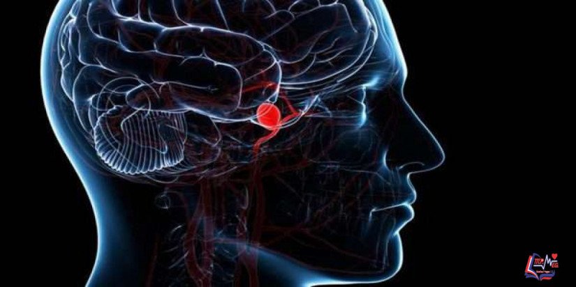 تمدد الأوعية الدموية في الدماغ Brain aneurysm