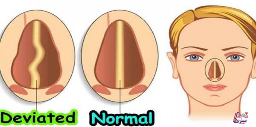 انحراف حاجز الأنف deviated nasal septum