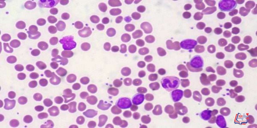 سرطان الدم النخاعي الحاد Acute myelogenous leukemia