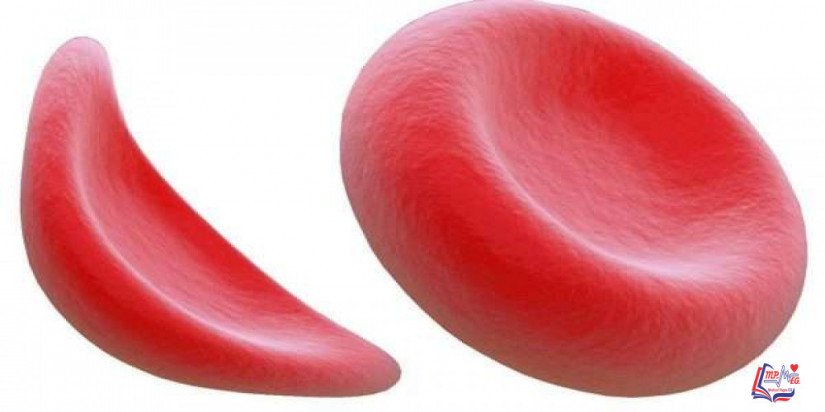 الانيميا المنجلية Sickle cell anemia