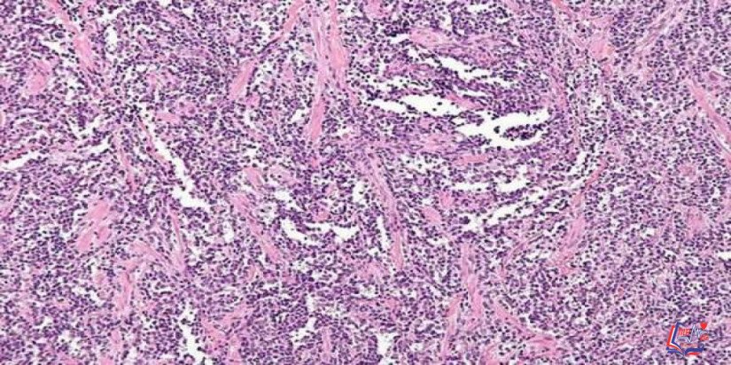 الساركوما العضلية المخططة Rhabdomyosarcoma