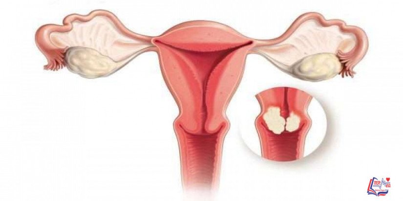 سرطان عنق الرحم cervical cancer