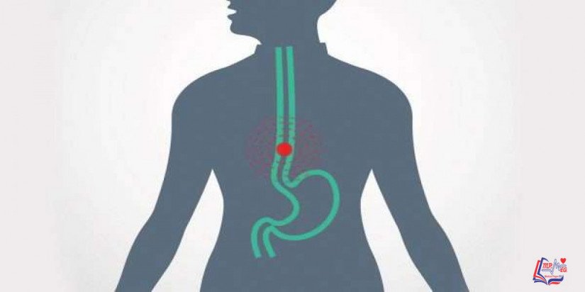 سرطان المريء Esophageal cancer