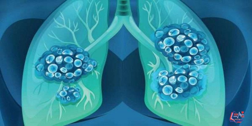 سرطان الرئة lung cancer