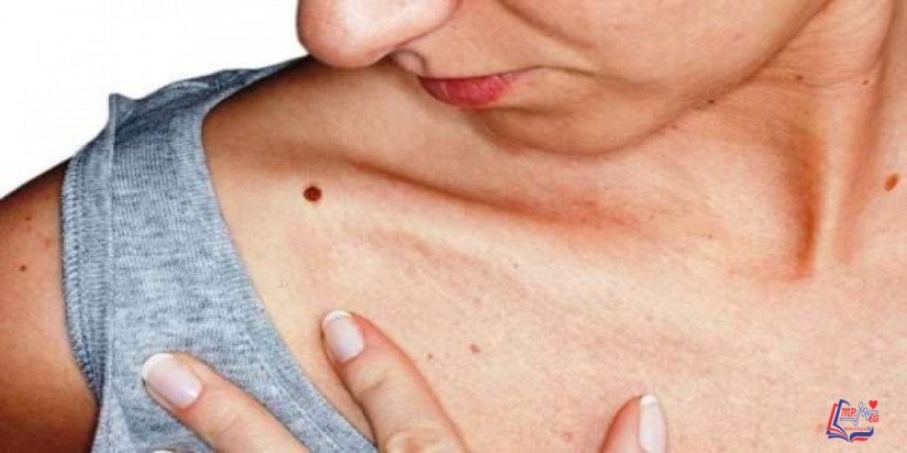 الميلانوما Melanoma