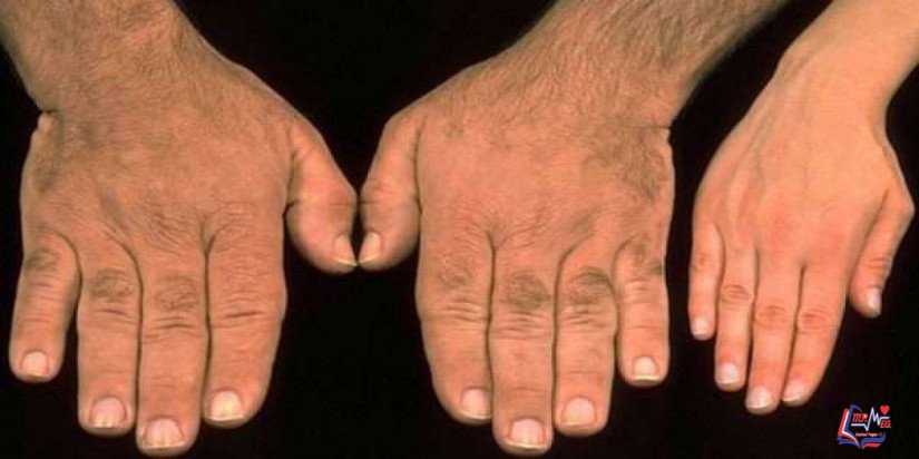 ضخامة الاطراف Acromegaly