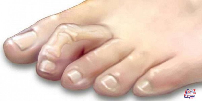 اصبع المطرقة Hammertoe and mallet toe