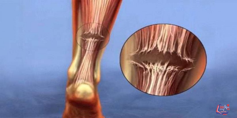 تمزق وتر العرقوب Achilles tendon rupture