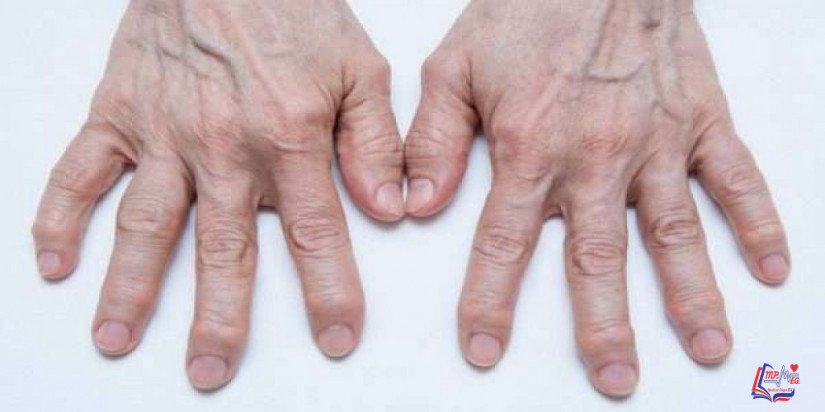 داء باجيت في العظام Pagets disease of bone