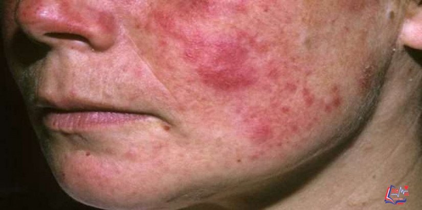 مرض الذئبة الحمراء Systemic lupus erythematosus