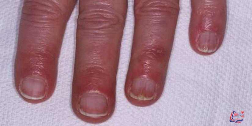 تثليج الاصابع Chilblains