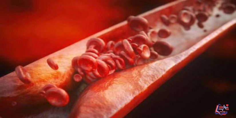 تصلب الشرايين Atherosclerosis