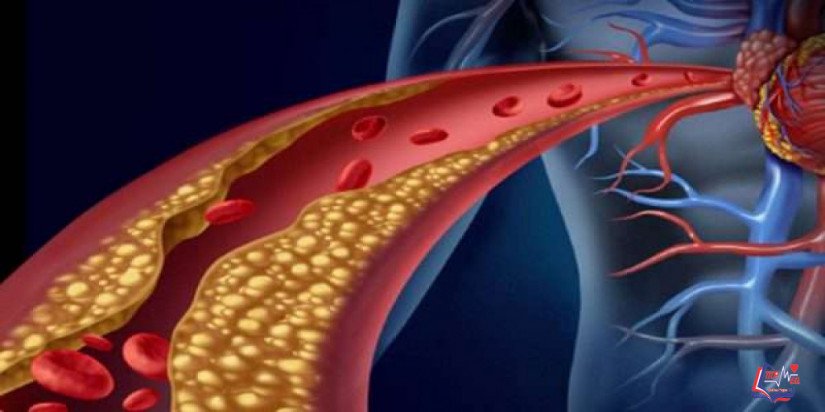 ارتفاع كوليسترول الدم العائلي Familial hypercholesterolemia