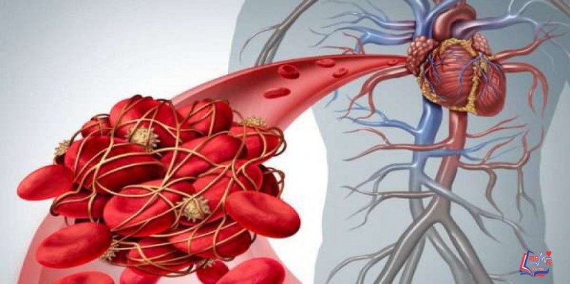 متلازمة اضداد الفوسفوليبيد Antiphospholipid syndrome