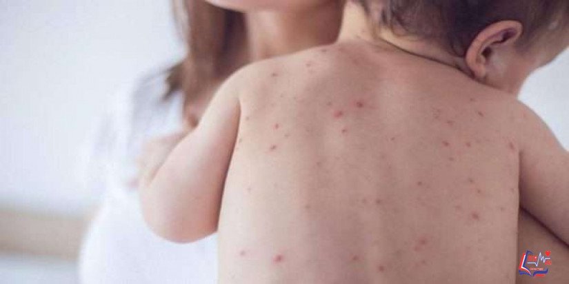 مرض الحصبة Measles