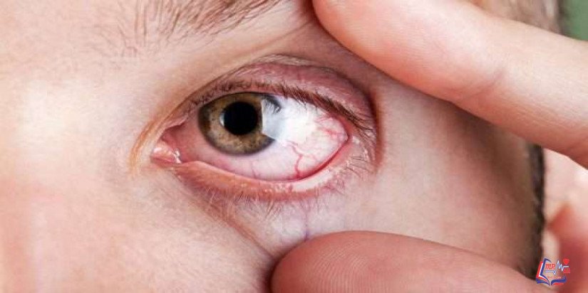 امراض القرنية Corneal diseases