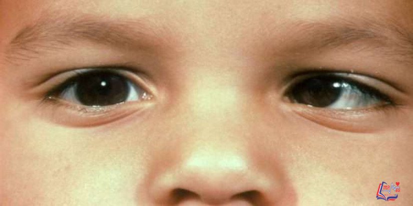 الحول Strabismus